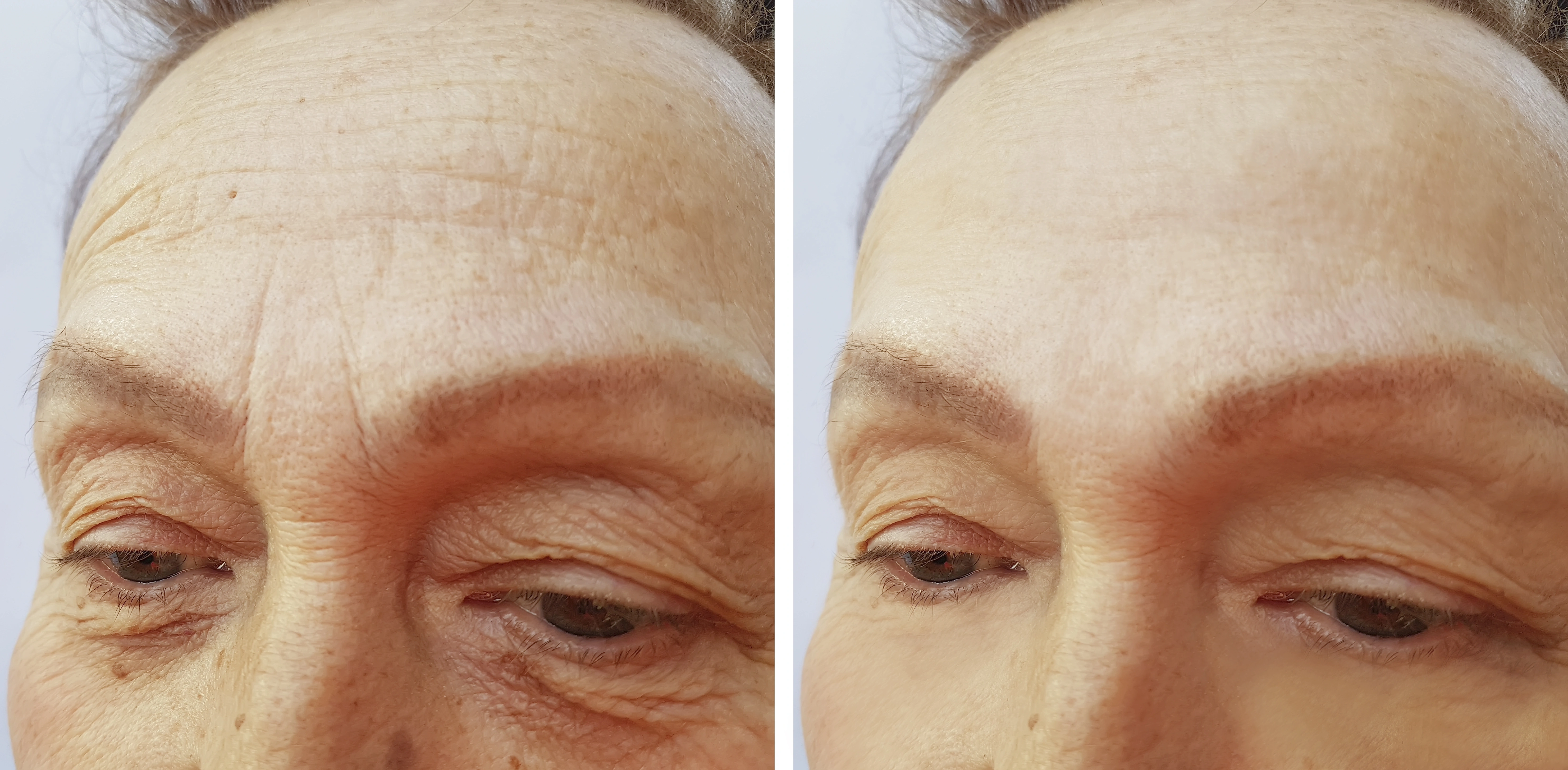 The potential benefits of anti wrinkle treatments